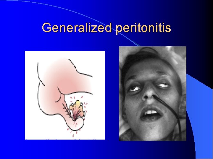Generalized peritonitis 