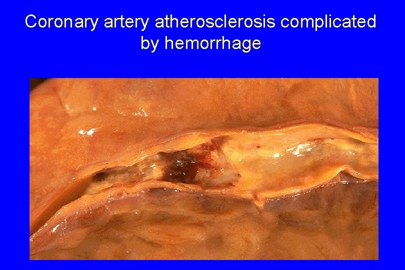 Coronary artery atherosclerosis complicated by hemorrhage 