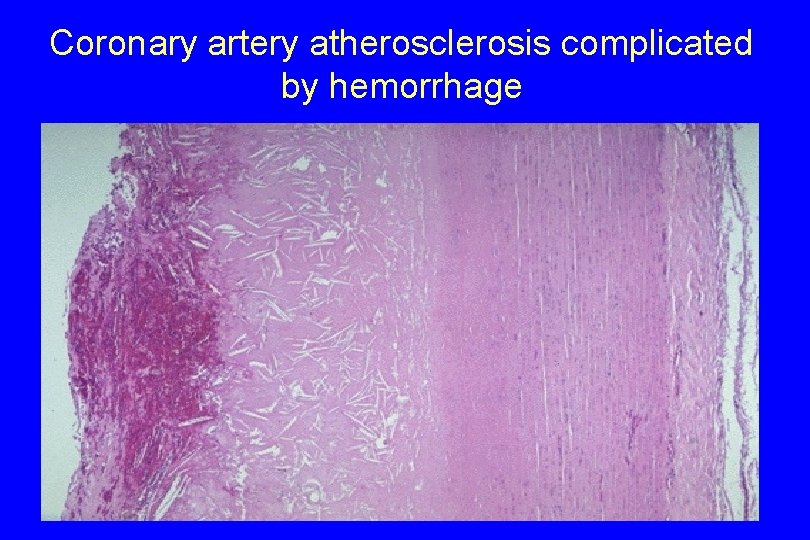 Coronary artery atherosclerosis complicated by hemorrhage 