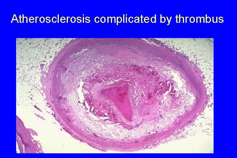 Atherosclerosis complicated by thrombus 