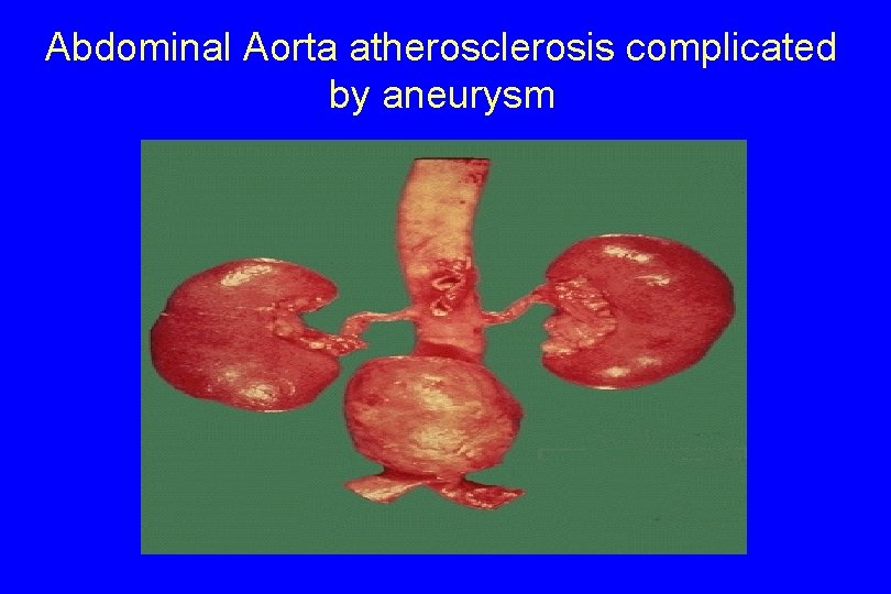 Abdominal Aorta atherosclerosis complicated by aneurysm 