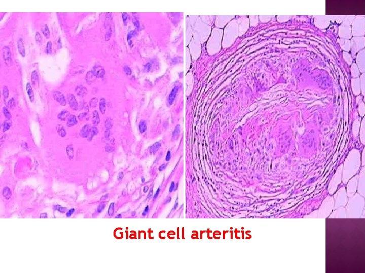 Giant cell arteritis 