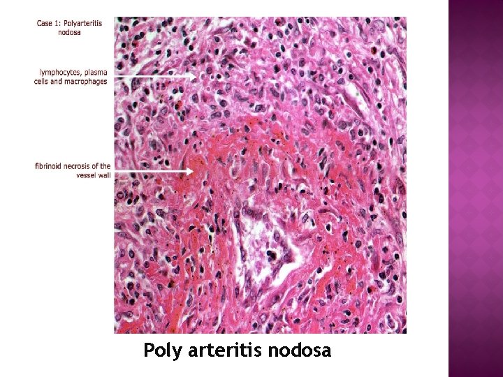 Poly arteritis nodosa 