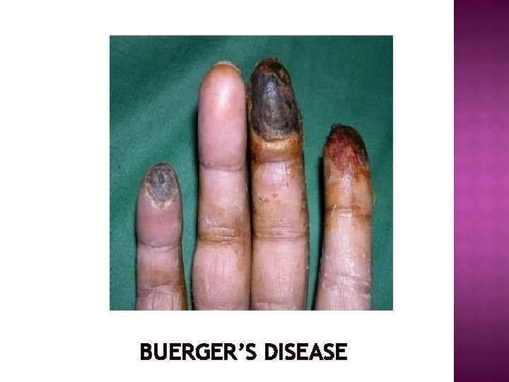 BUERGER’S DISEASE 