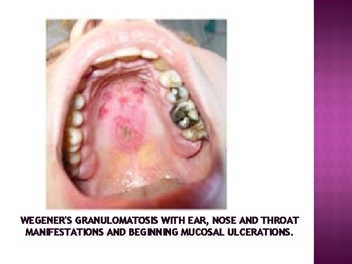 WEGENER'S GRANULOMATOSIS WITH EAR, NOSE AND THROAT MANIFESTATIONS AND BEGINNING MUCOSAL ULCERATIONS. 