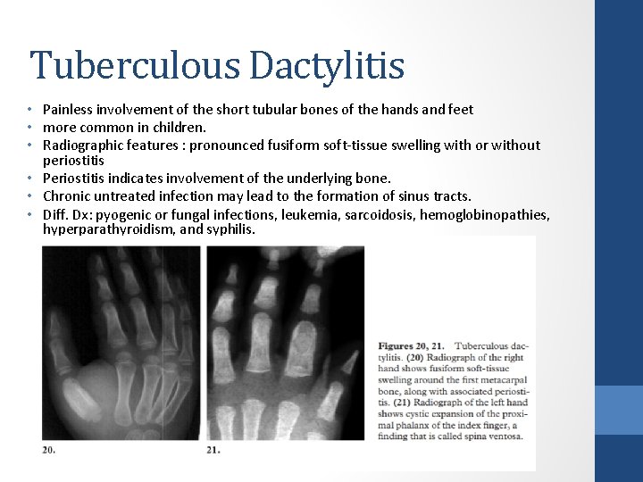 Tuberculous Dactylitis • Painless involvement of the short tubular bones of the hands and