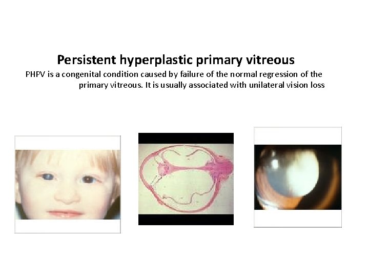 Persistent hyperplastic primary vitreous PHPV is a congenital condition caused by failure of the