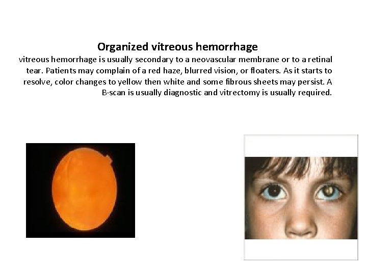 Organized vitreous hemorrhage is usually secondary to a neovascular membrane or to a retinal