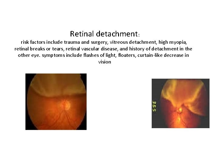 Retinal detachment: risk factors include trauma and surgery, vitreous detachment, high myopia, retinal breaks