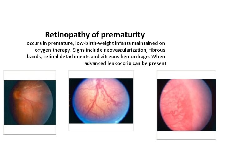 Retinopathy of prematurity occurs in premature, low-birth-weight infants maintained on oxygen therapy. Signs include