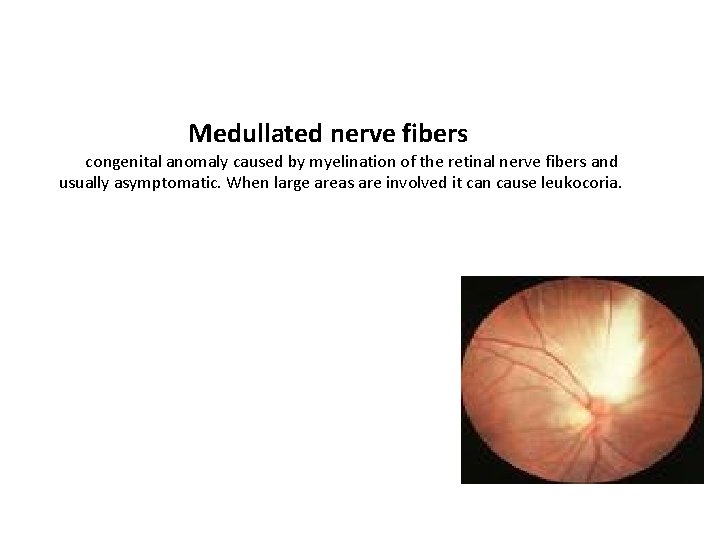 Medullated nerve fibers congenital anomaly caused by myelination of the retinal nerve fibers and