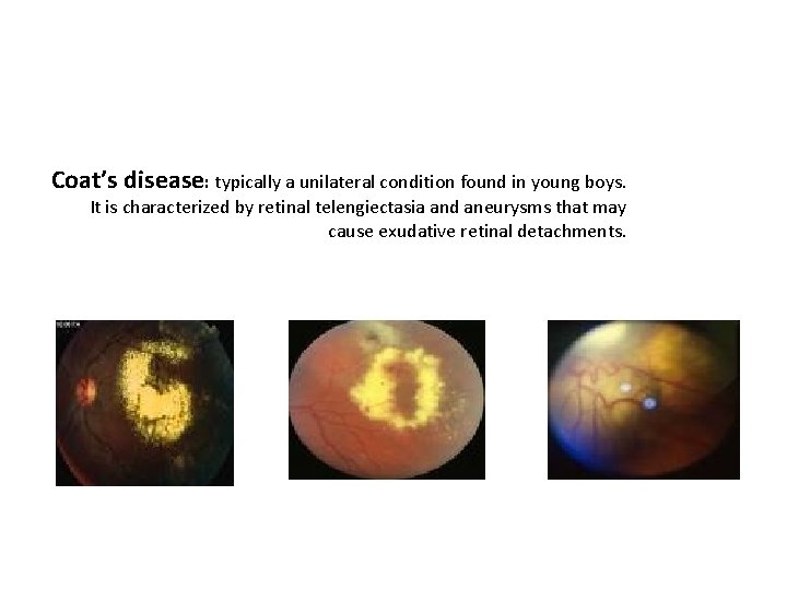 Coat’s disease: typically a unilateral condition found in young boys. It is characterized by