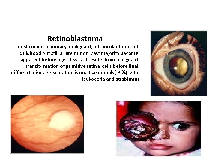 Retinoblastoma most common primary, malignant, intraocular tumor of childhood but still a rare tumor.