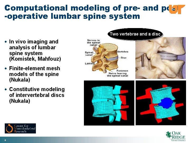 Computational modeling of pre- and post -operative lumbar spine system Two vertebrae and a