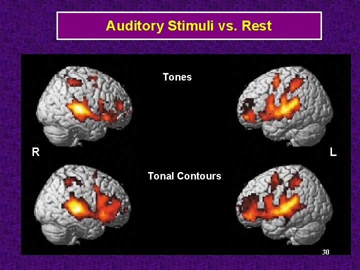Auditory Stimuli vs. Rest Tones R L Tonal Contours 30 