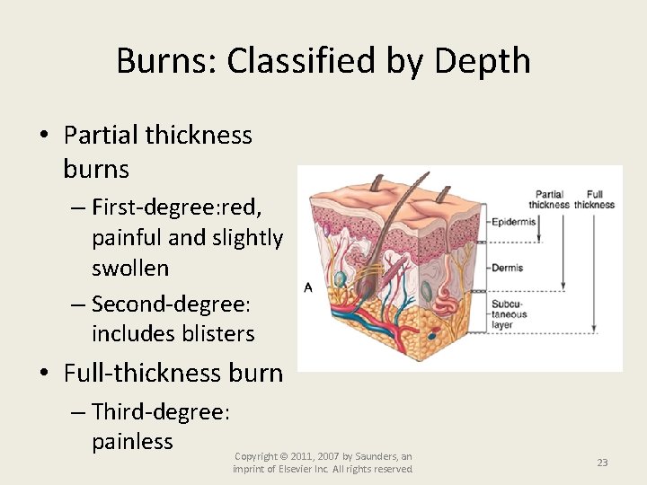 Burns: Classified by Depth • Partial thickness burns – First-degree: red, painful and slightly