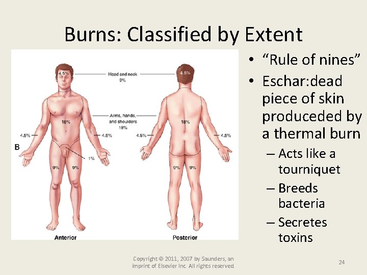 Burns: Classified by Extent • “Rule of nines” • Eschar: dead piece of skin