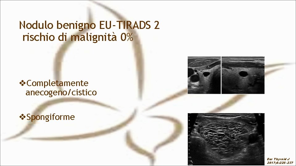 Nodulo benigno EU-TIRADS 2 rischio di malignità 0% v. Completamente anecogeno/cistico v. Spongiforme Eur