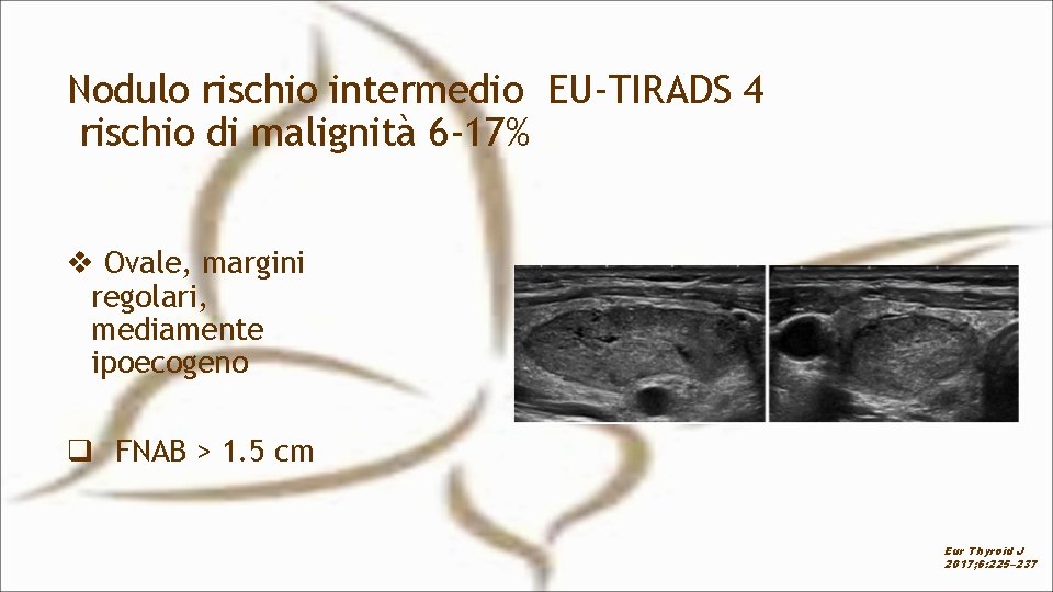 Nodulo rischio intermedio EU-TIRADS 4 rischio di malignità 6 -17% v Ovale, margini regolari,