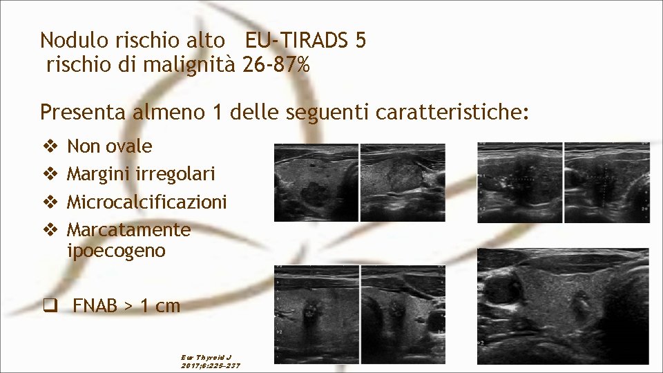 Nodulo rischio alto EU-TIRADS 5 rischio di malignità 26 -87% Presenta almeno 1 delle