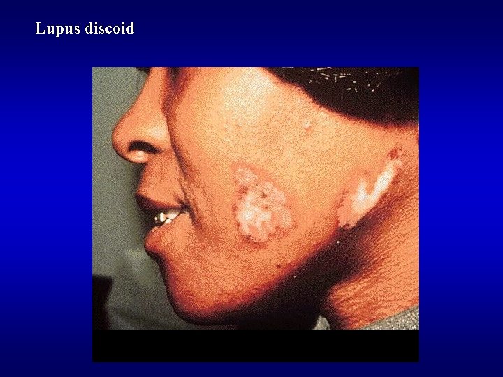 Lupus discoid 