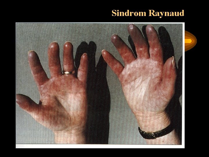 Sindrom Raynaud 