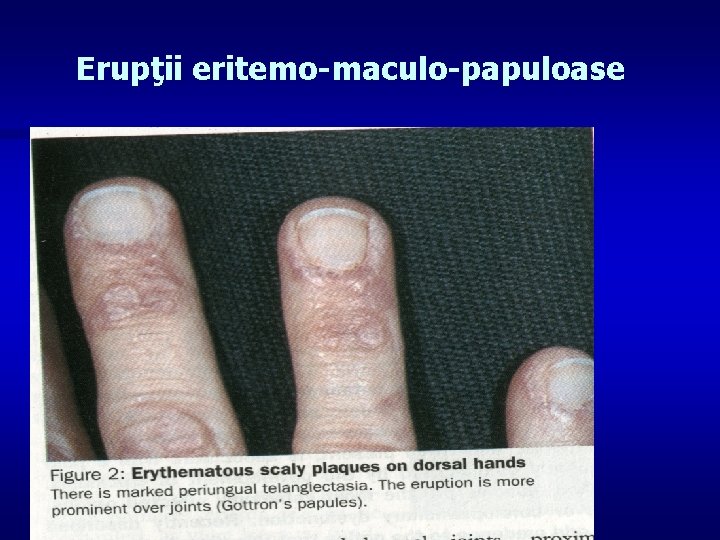 Erupţii eritemo-maculo-papuloase 