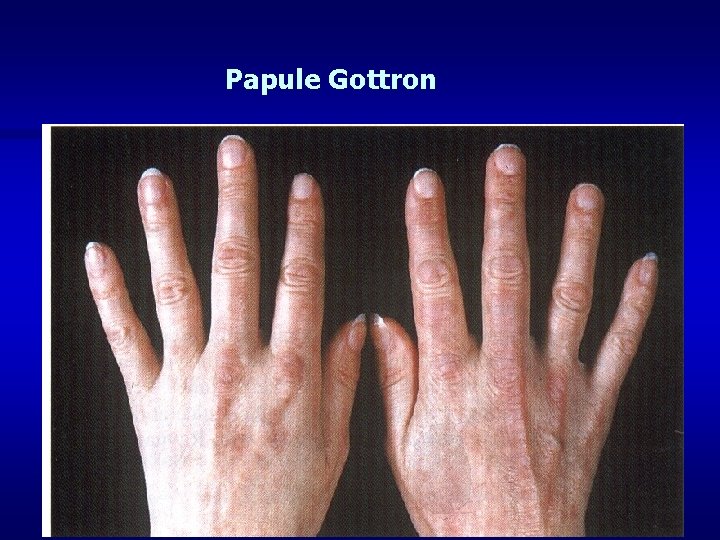 Papule Gottron 