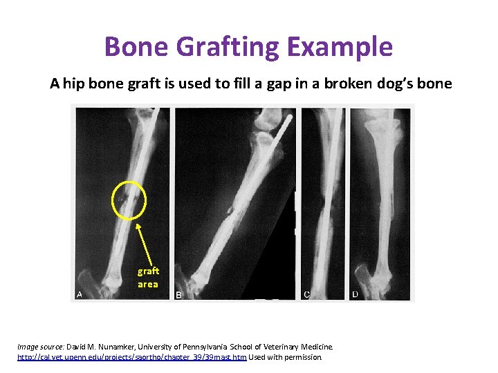Bone Grafting Example A hip bone graft is used to fill a gap in