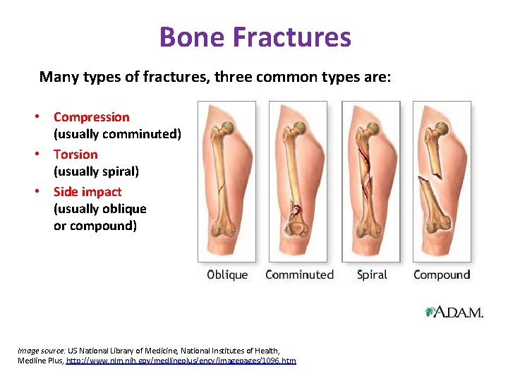 Bone Fractures Many types of fractures, three common types are: • Compression (usually comminuted)