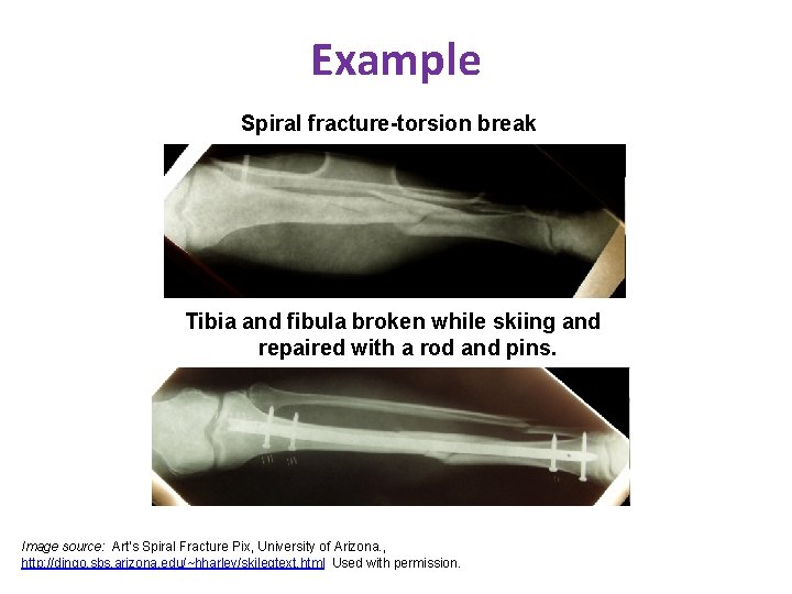 Example Spiral fracture-torsion break Tibia and fibula broken while skiing and repaired with a