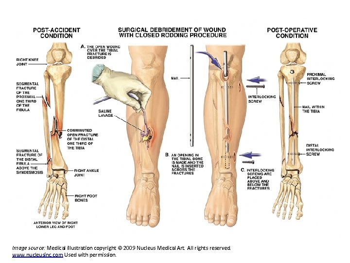 Image source: Medical illustration copyright © 2009 Nucleus Medical Art. All rights reserved. www.