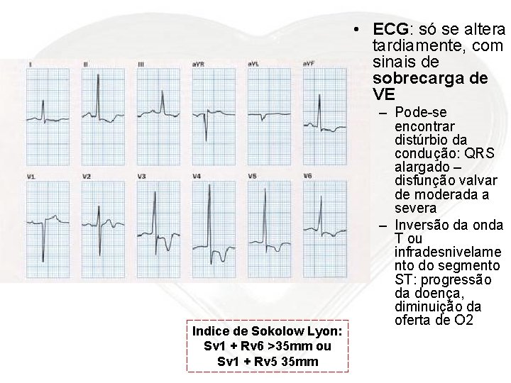  • ECG: só se altera tardiamente, com sinais de sobrecarga de VE Indice