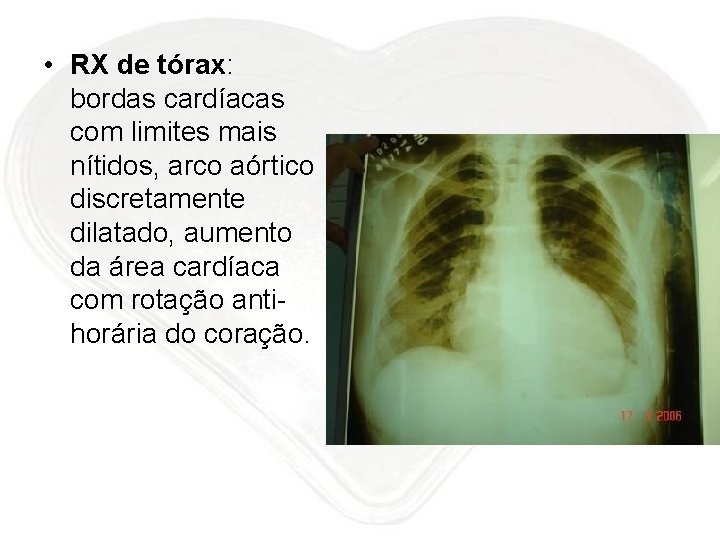  • RX de tórax: bordas cardíacas com limites mais nítidos, arco aórtico discretamente