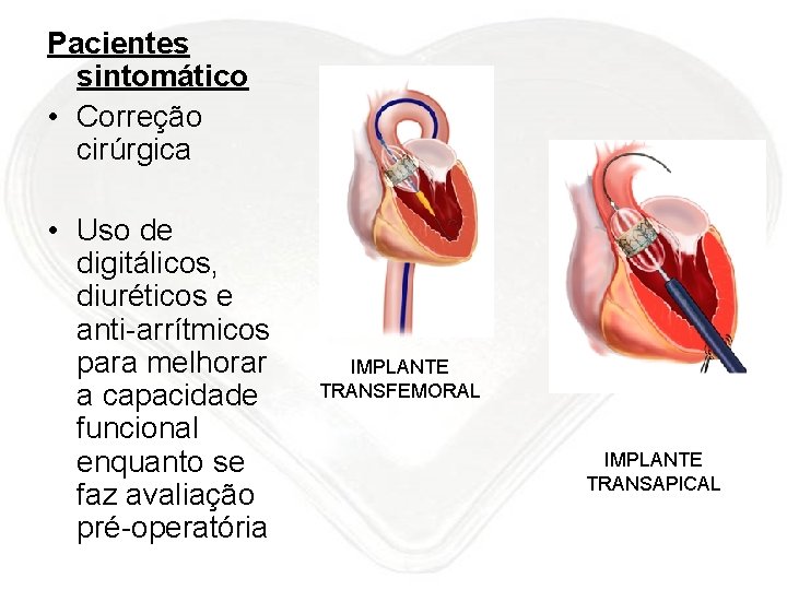Pacientes sintomático • Correção cirúrgica • Uso de digitálicos, diuréticos e anti-arrítmicos para melhorar