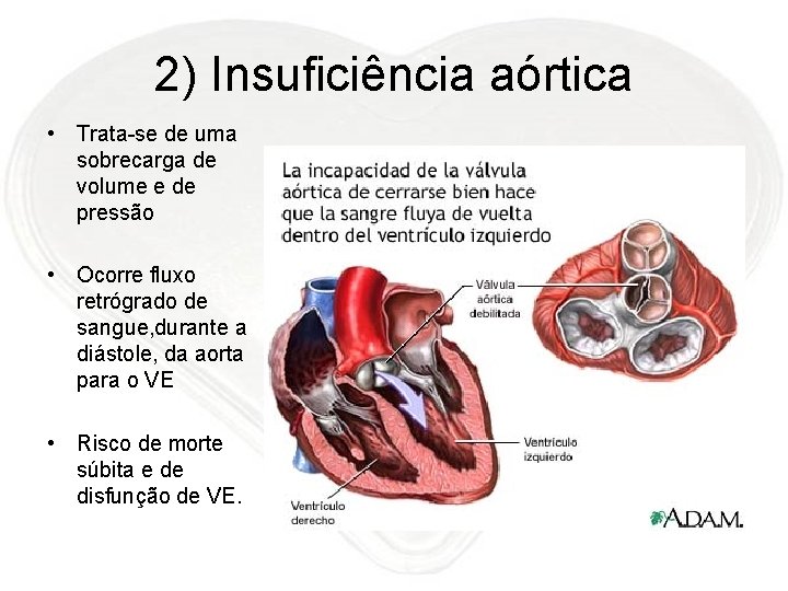 2) Insuficiência aórtica • Trata-se de uma sobrecarga de volume e de pressão •