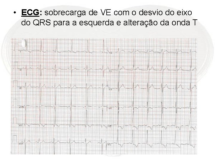  • ECG: sobrecarga de VE com o desvio do eixo do QRS para
