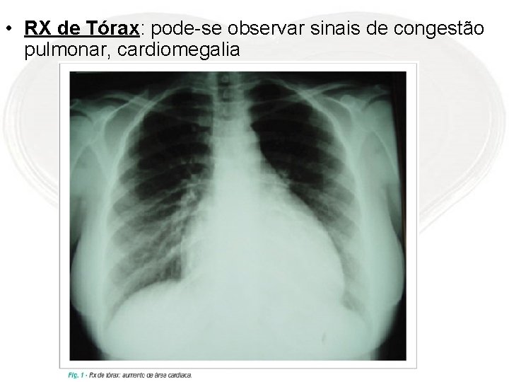  • RX de Tórax: pode-se observar sinais de congestão pulmonar, cardiomegalia 