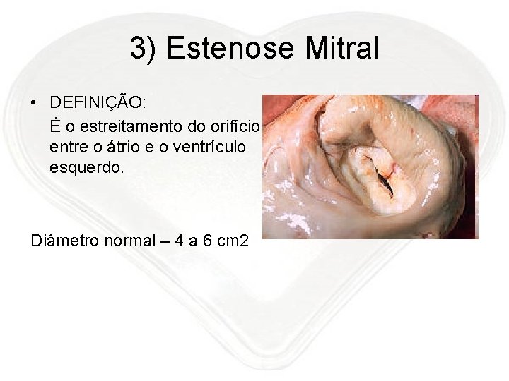 3) Estenose Mitral • DEFINIÇÃO: É o estreitamento do orifício entre o átrio e