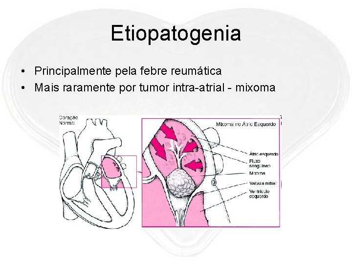 Etiopatogenia • Principalmente pela febre reumática • Mais raramente por tumor intra-atrial - mixoma