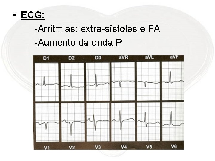  • ECG: -Arritmias: extra-sístoles e FA -Aumento da onda P 