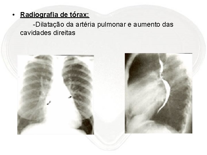  • Radiografia de tórax: -Dilatação da artéria pulmonar e aumento das cavidades direitas
