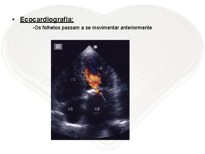  • Ecocardiografia: -Os folhetos passam a se movimentar anteriormente 