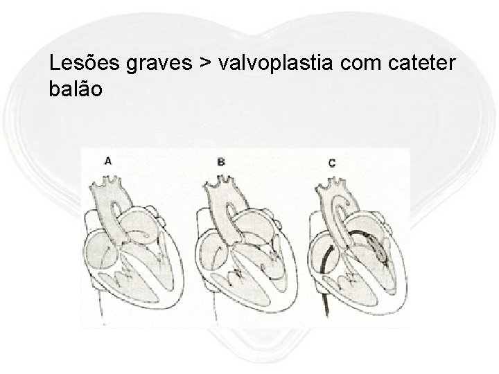 Lesões graves > valvoplastia com cateter balão 