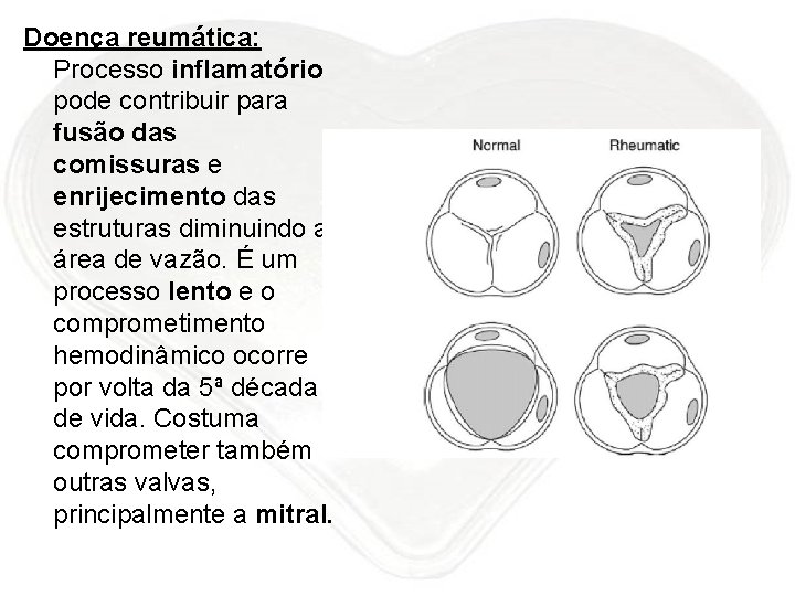 Doença reumática: Processo inflamatório pode contribuir para fusão das comissuras e enrijecimento das estruturas