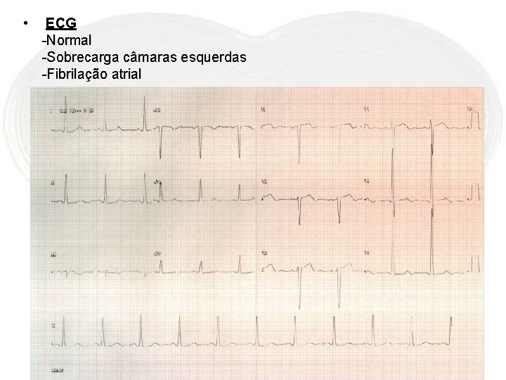  • ECG -Normal -Sobrecarga câmaras esquerdas -Fibrilação atrial 