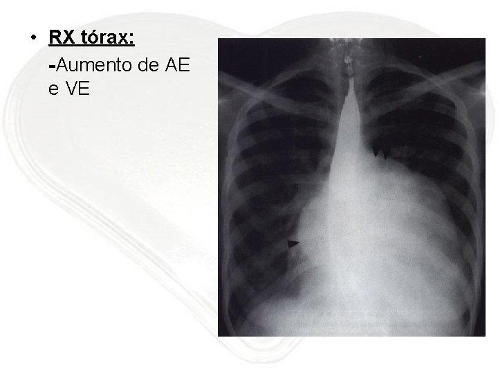  • RX tórax: -Aumento de AE e VE 