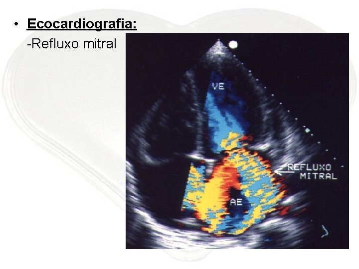  • Ecocardiografia: -Refluxo mitral 