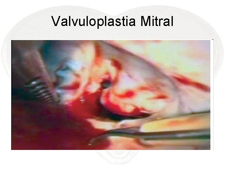 Valvuloplastia Mitral 