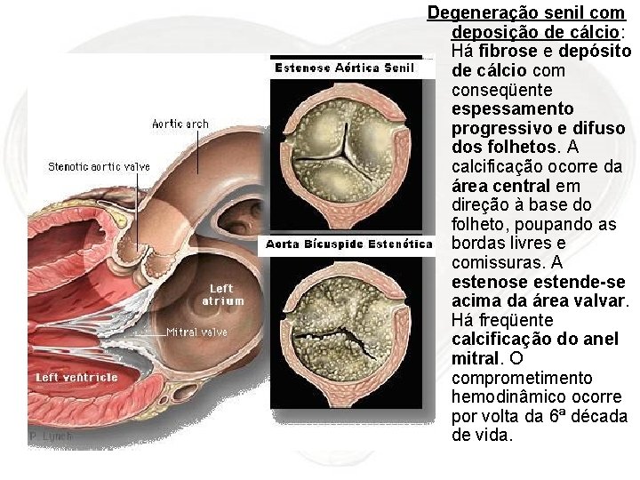 Degeneração senil com deposição de cálcio: Há fibrose e depósito de cálcio com conseqüente